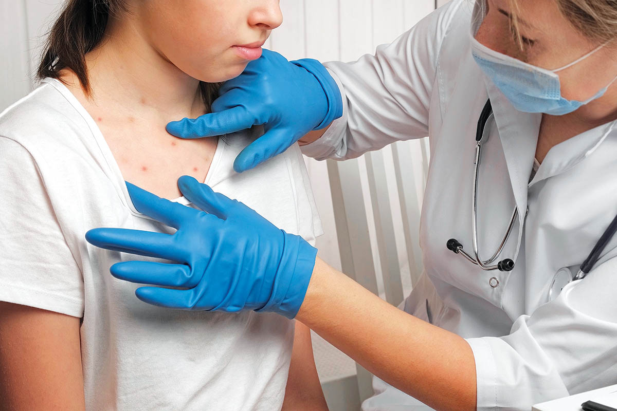 ΠΟΥ: Ραγδαία η διασπορά της νόσου mpox