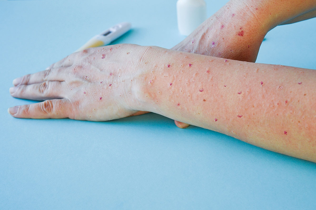 Καμπανάκι ΠΟΥ για την Mpox